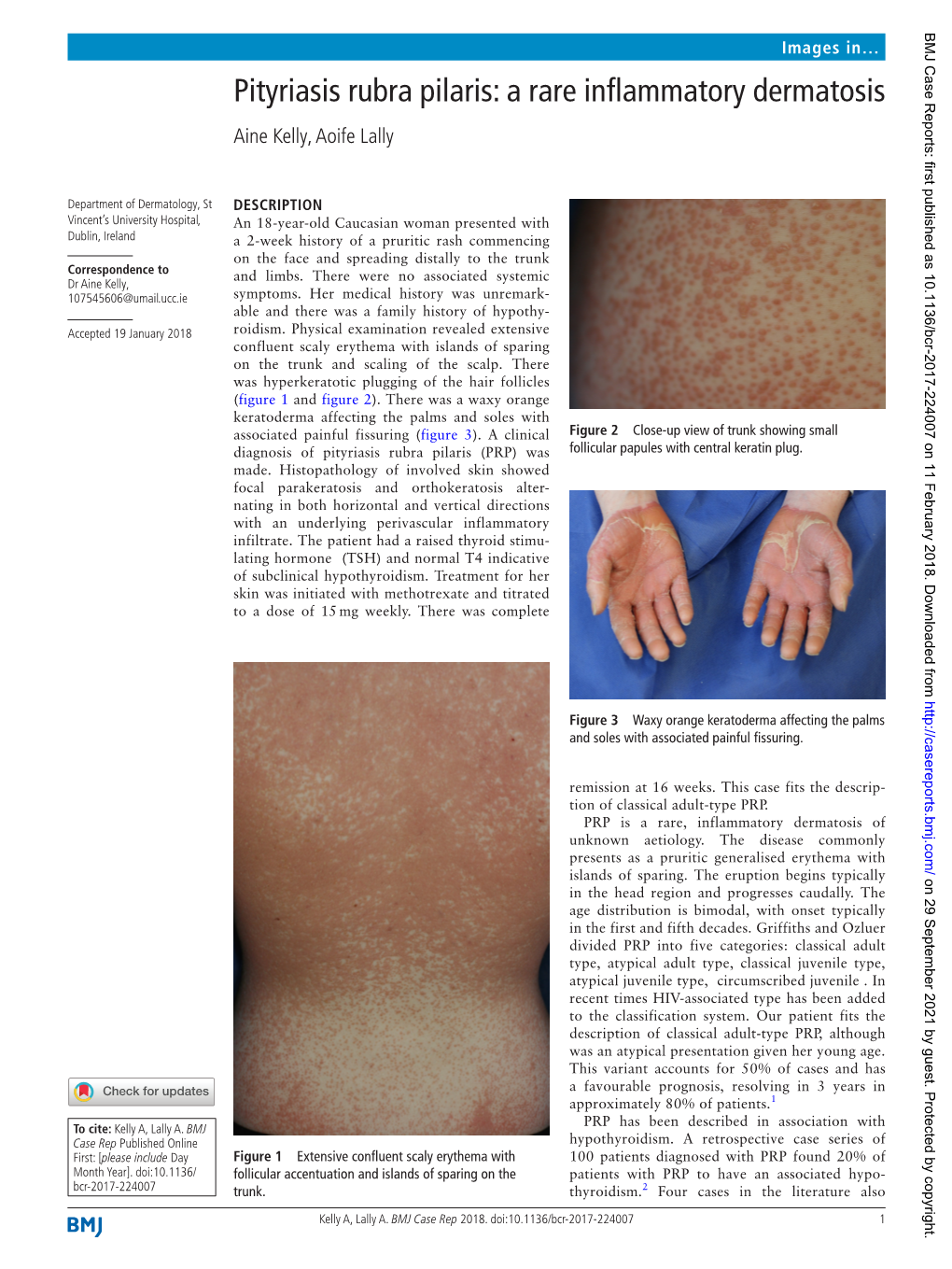 Pityriasis Rubra Pilaris: a Rare Inflammatory Dermatosis Aine Kelly, Aoife Lally