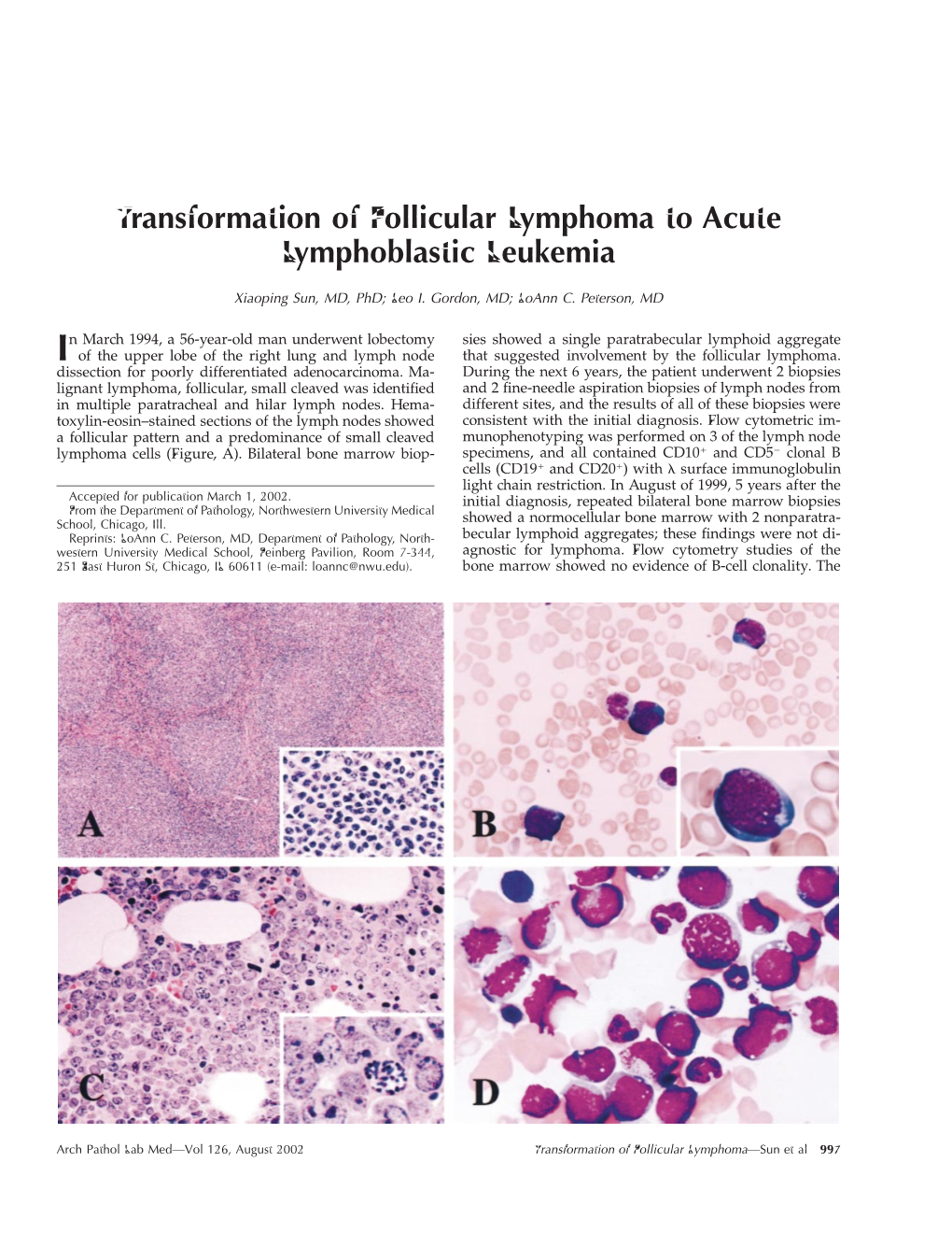 Transformation of Follicular Lymphoma to Acute Lymphoblastic Leukemia