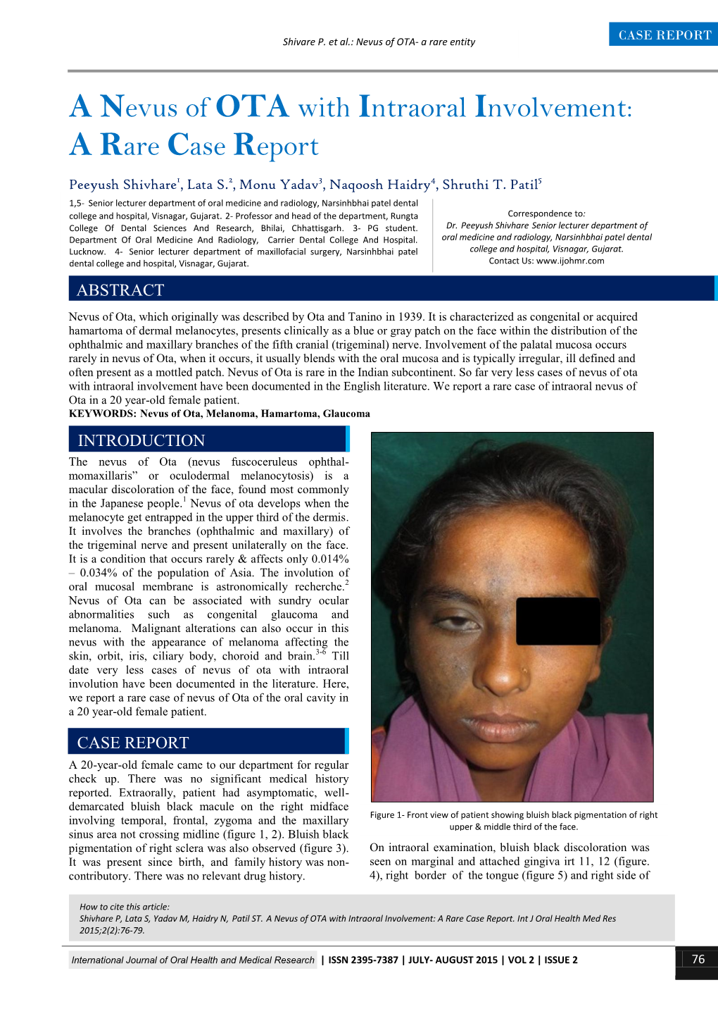 A Nevus of OTA with Intraoral Involvement: a Rare Case Report