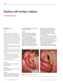 Dealing with Lentigo Maligna