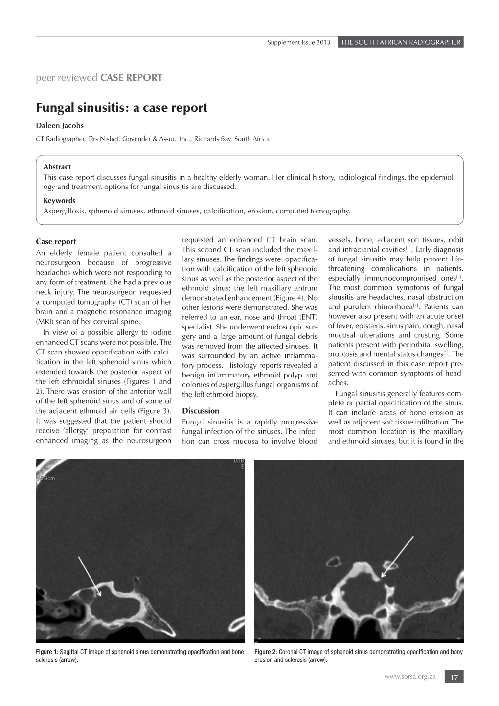 Fungal Sinusitis: a Case Report Daleen Jacobs CT Radiographer, Drs Nisbet, Govender & Assoc