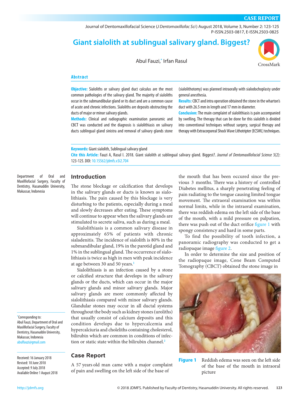 Giant Sialolith at Sublingual Salivary Gland. Biggest? 4