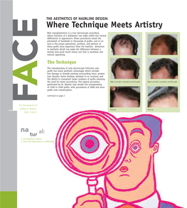 Where Technique Meets Artistry Hair Transplantation Is a True Microscopic Procedure, Where Fractions of a Millimeter Can Make Subtle but Critical