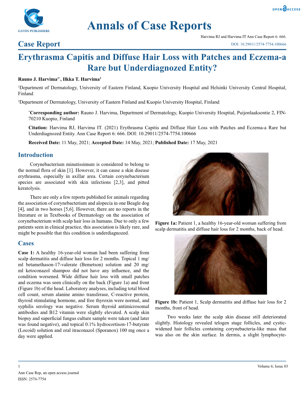 Erythrasma Capitis and Diffuse Hair Loss with Patches and Eczema-A Rare but Underdiagnozed Entity? Rauno J