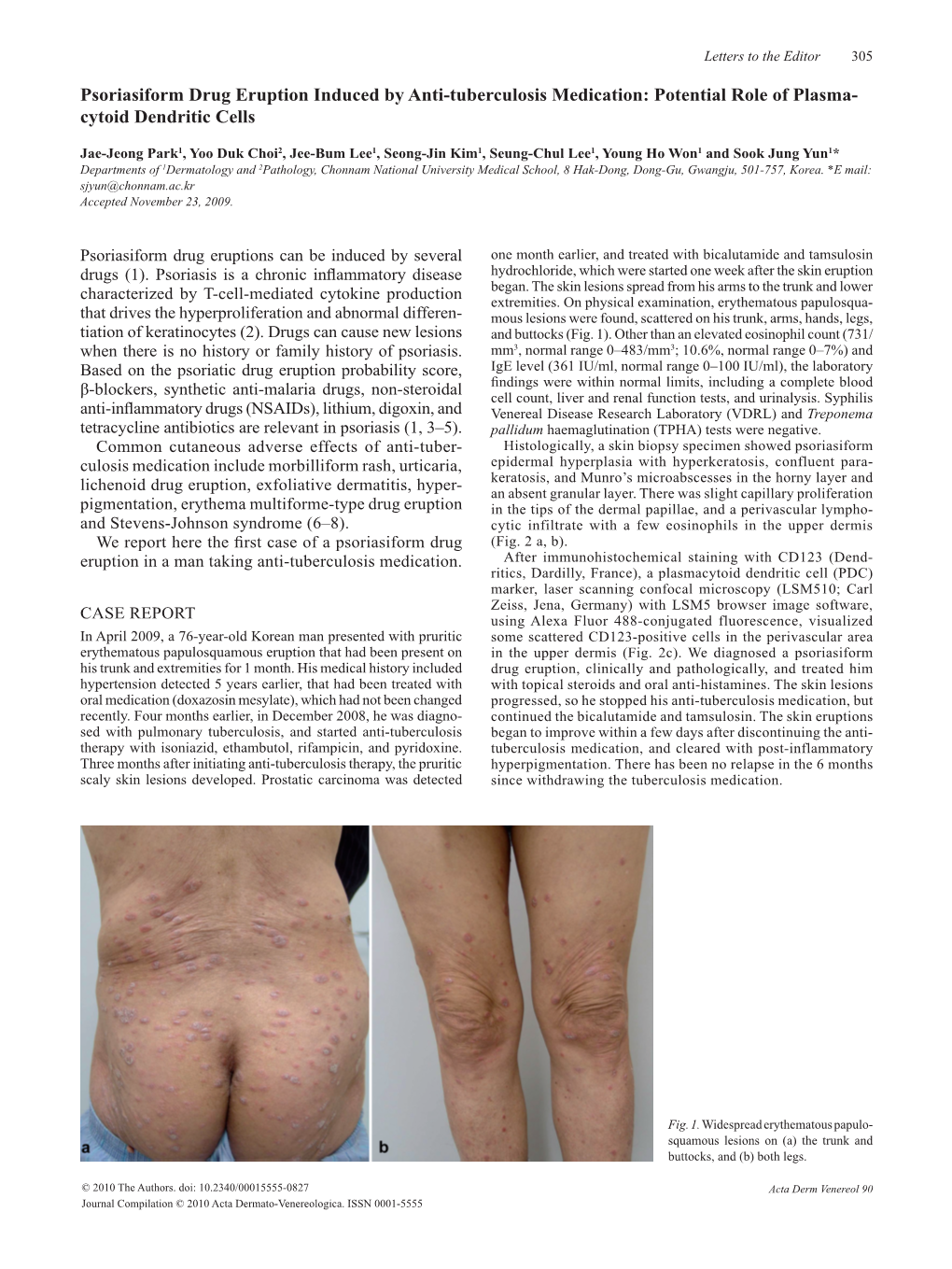 Psoriasiform Drug Eruption Induced by Anti-Tuberculosis Medication: Potential Role of Plasma­ Cytoid Dendritic Cells