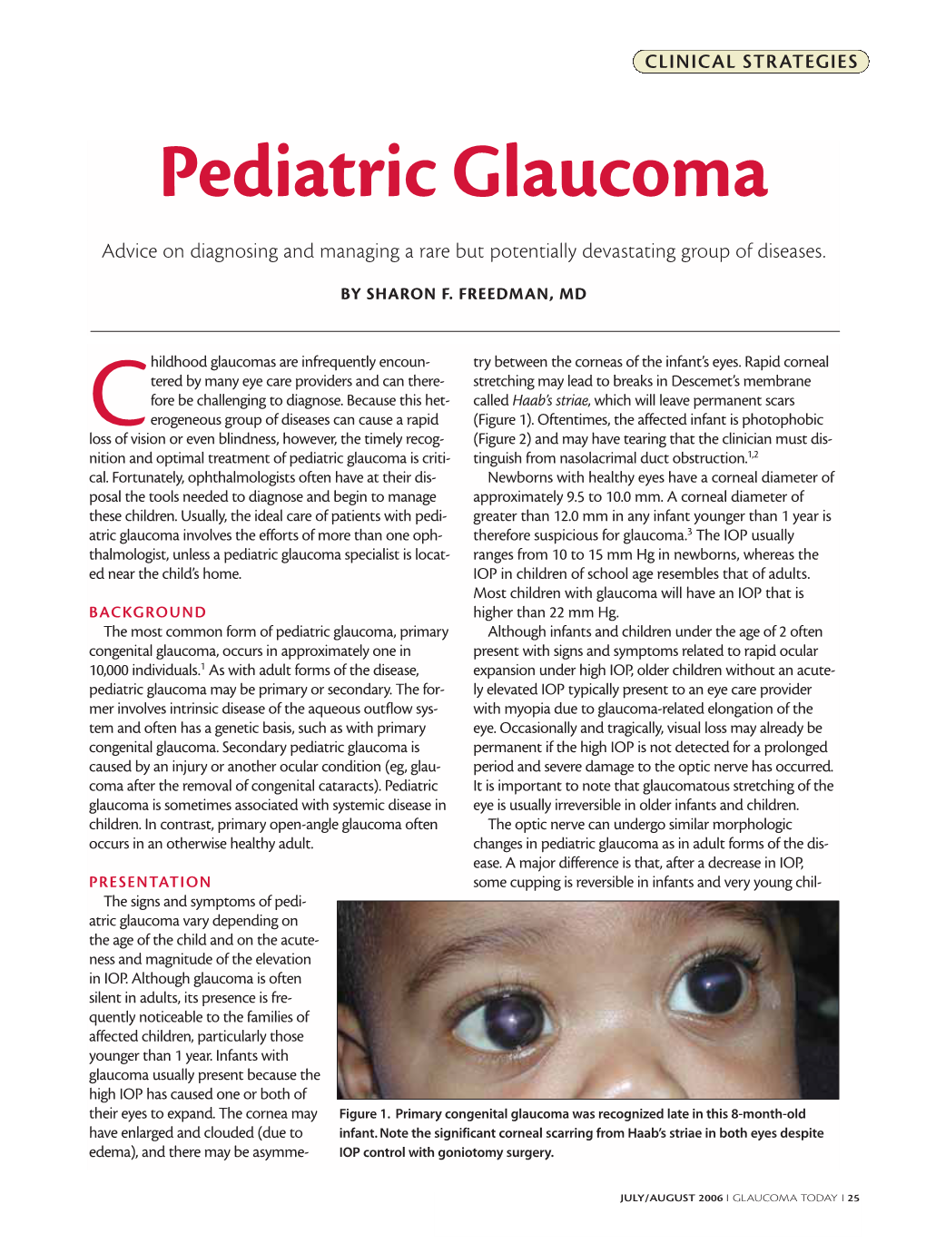 Pediatric Glaucoma