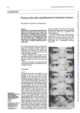 Ptosis As the Early Manifestation of Pituitary Tumour