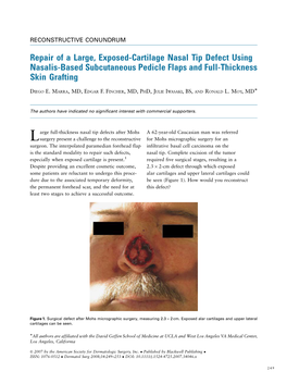Repair of a Large, Exposed-Cartilage Nasal Tip Defect Using Nasalis-Based Subcutaneous Pedicle Flaps and Full-Thickness Skin Grafting Ã DIEGO E