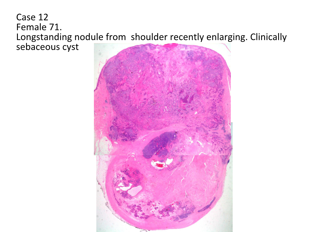 Case 12 Female 71. Longstanding Nodule from Shoulder Recently Enlarging