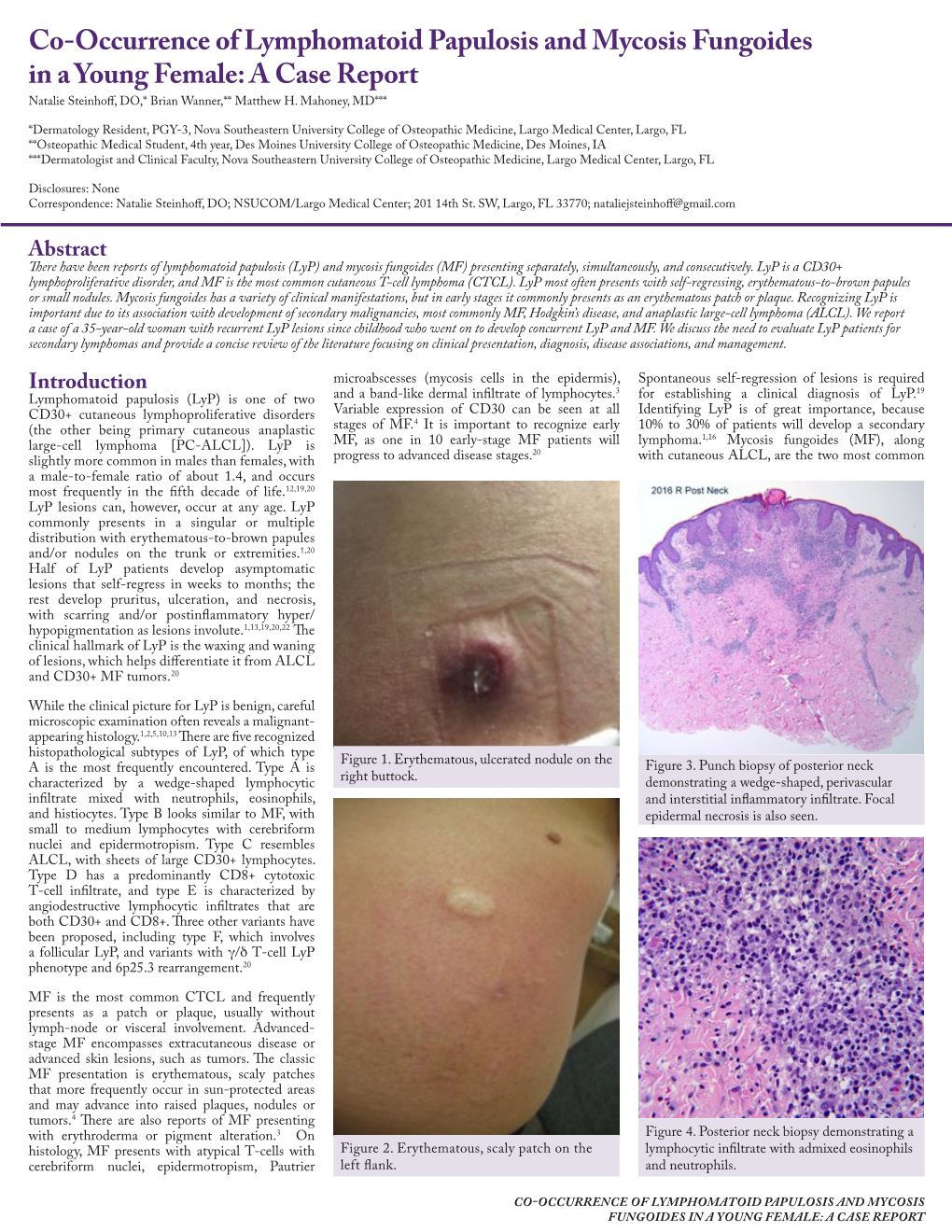 Co-Occurrence of Lymphomatoid Papulosis and Mycosis Fungoides in a Young Female: a Case Report Natalie Steinhoff, DO,* Brian Wanner,** Matthew H