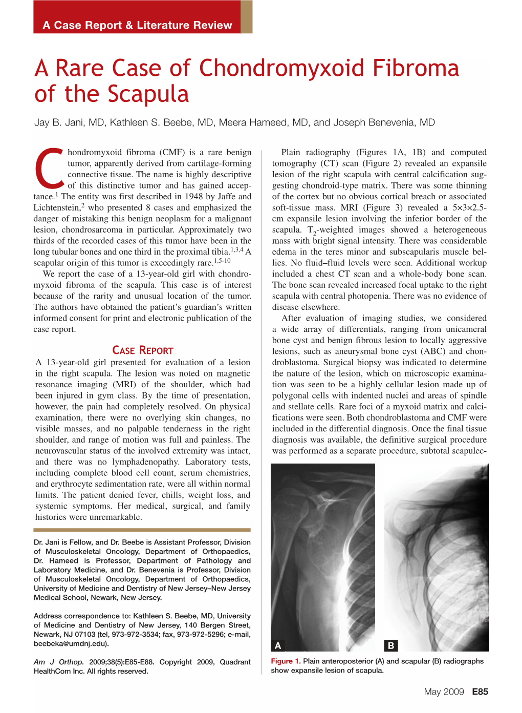 A Rare Case of Chondromyxoid Fibroma of the Scapula Jay B