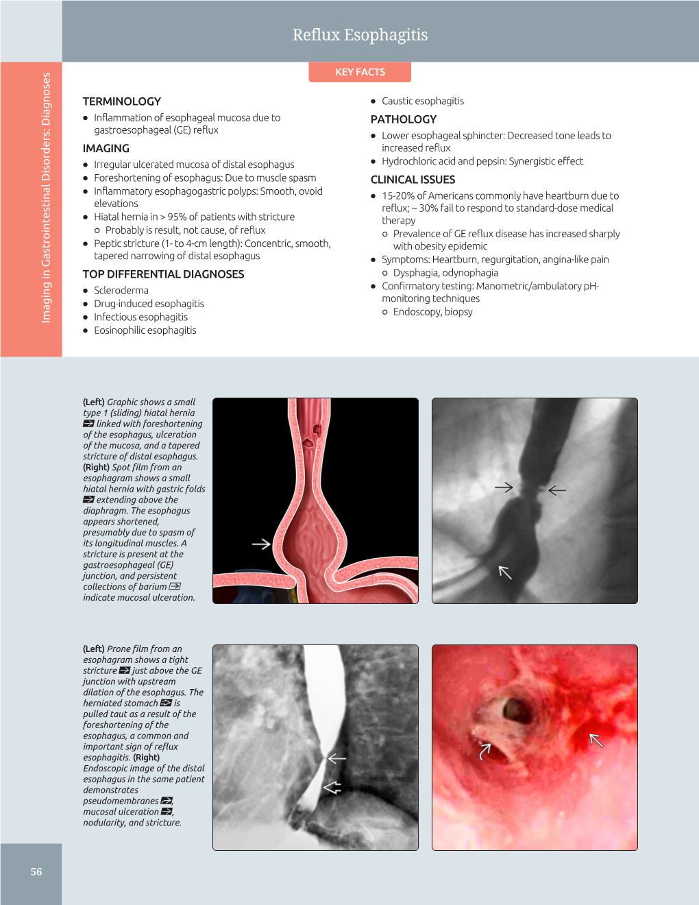 Reflux Esophagitis