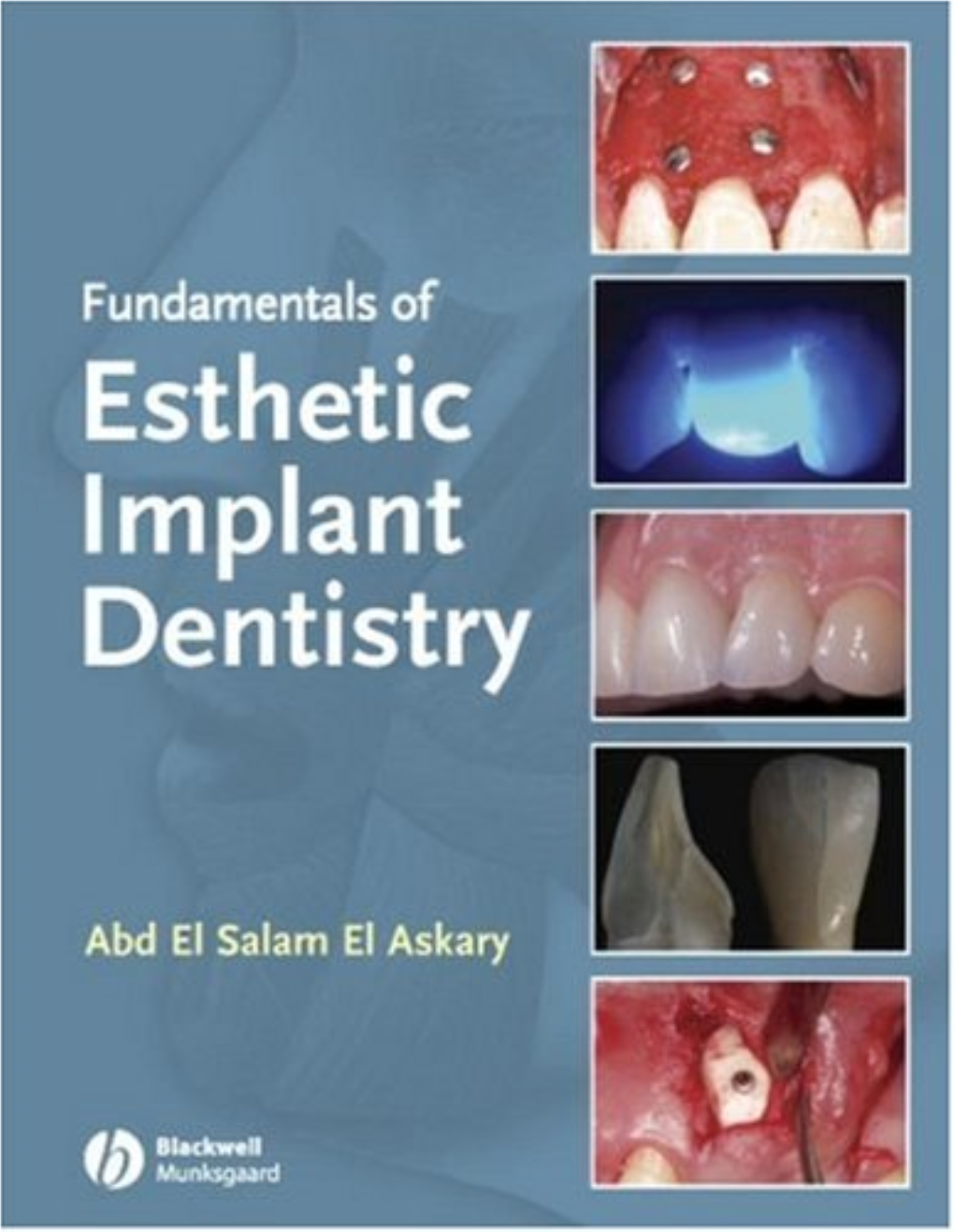 The Art and Science of Shade Matching in Esthetic Implant Dentistry, 275 Chapter 12 Treatment Complications in the Esthetic Zone, 301