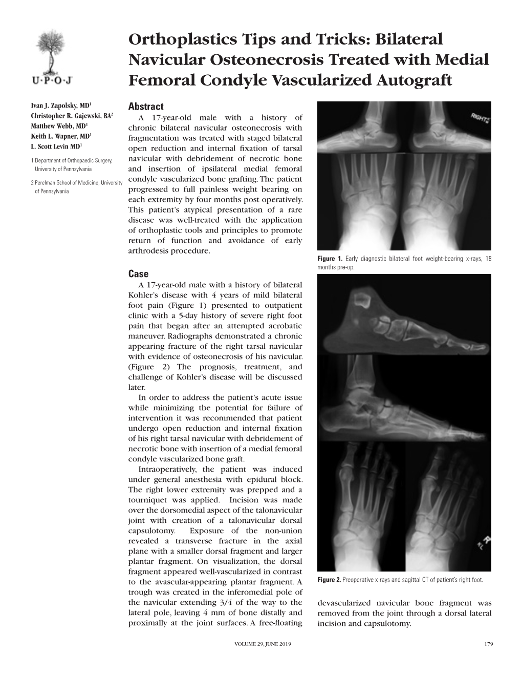 Bilateral Navicular Osteonecrosis Treated with Medial Femoral Condyle Vascularized Autograft