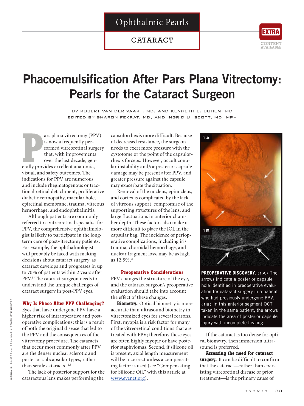 Phacoemulsification After Pars Plana Vitrectomy: Pearls for the Cataract Surgeon