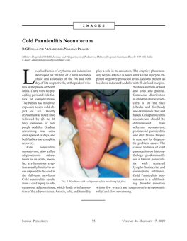 Cold Panniculitis Neonatorum