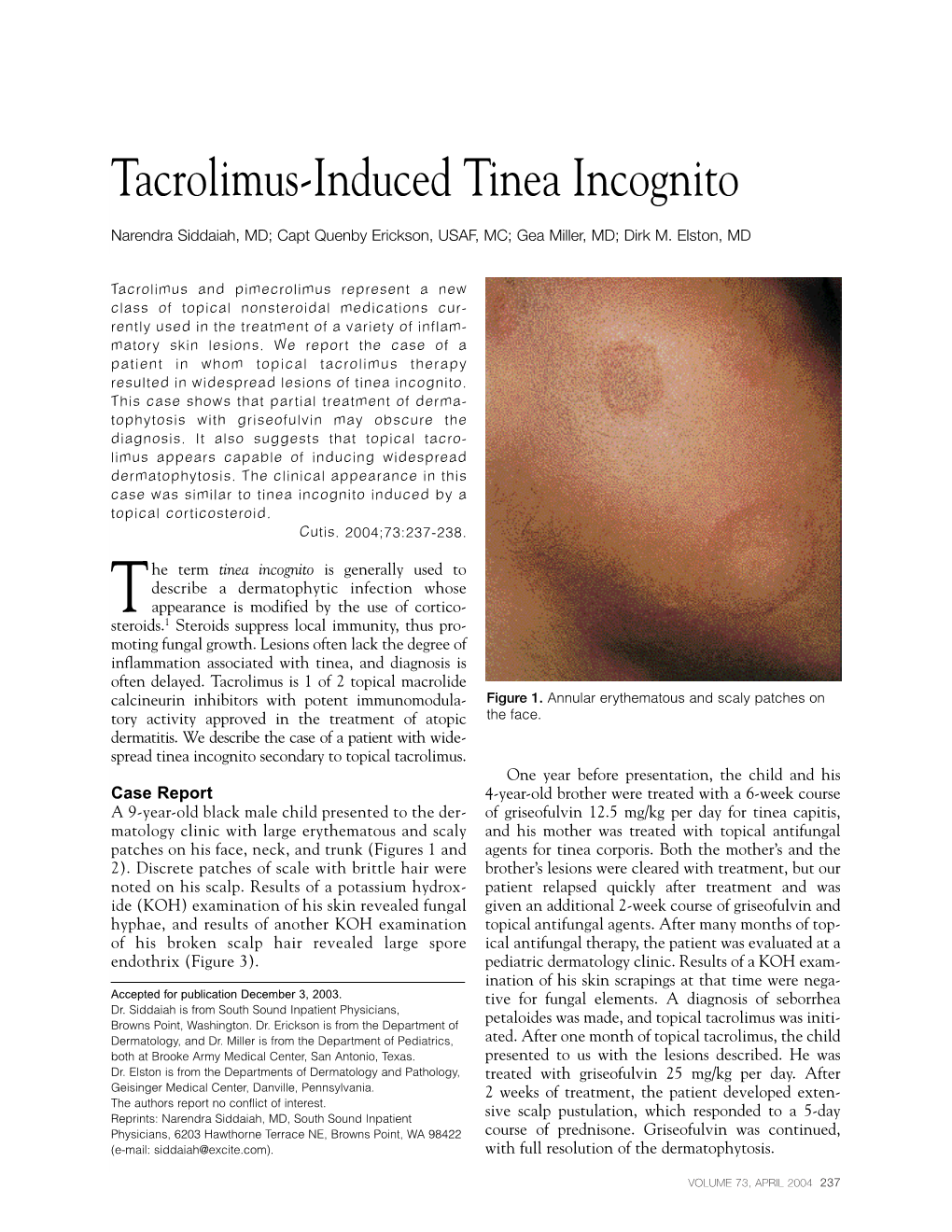 Tacrolimus-Induced Tinea Incognito