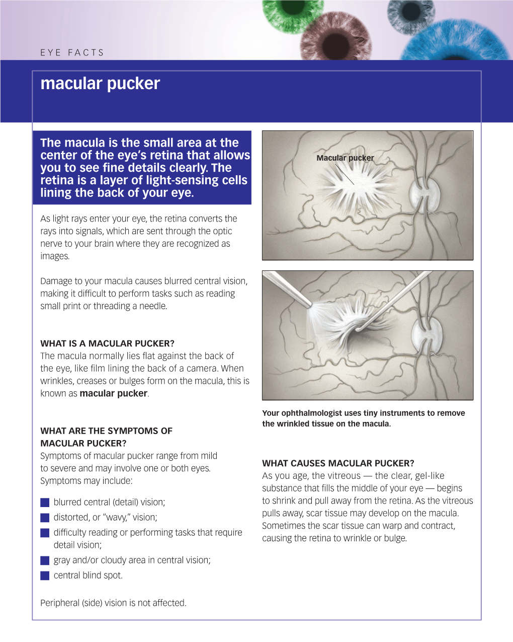 Macular Pucker