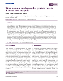 Tinea Manuum Misdiagnosed As Psoriasis Vulgaris: a Case of Tinea Incognito