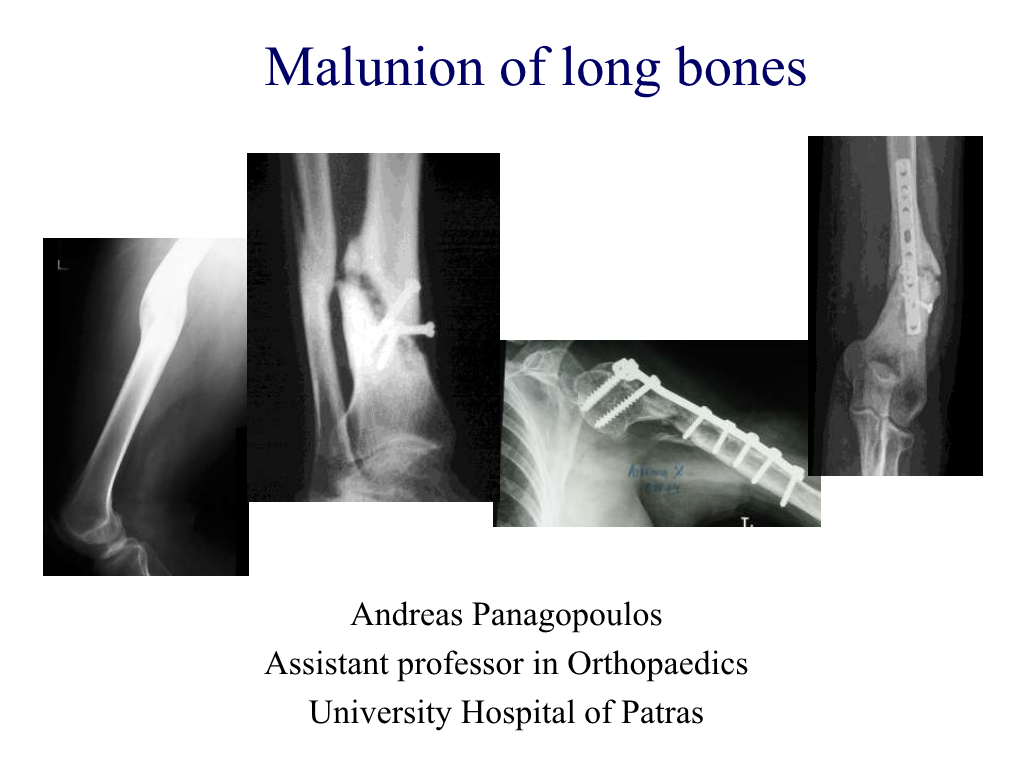 Malunion of Long Bones