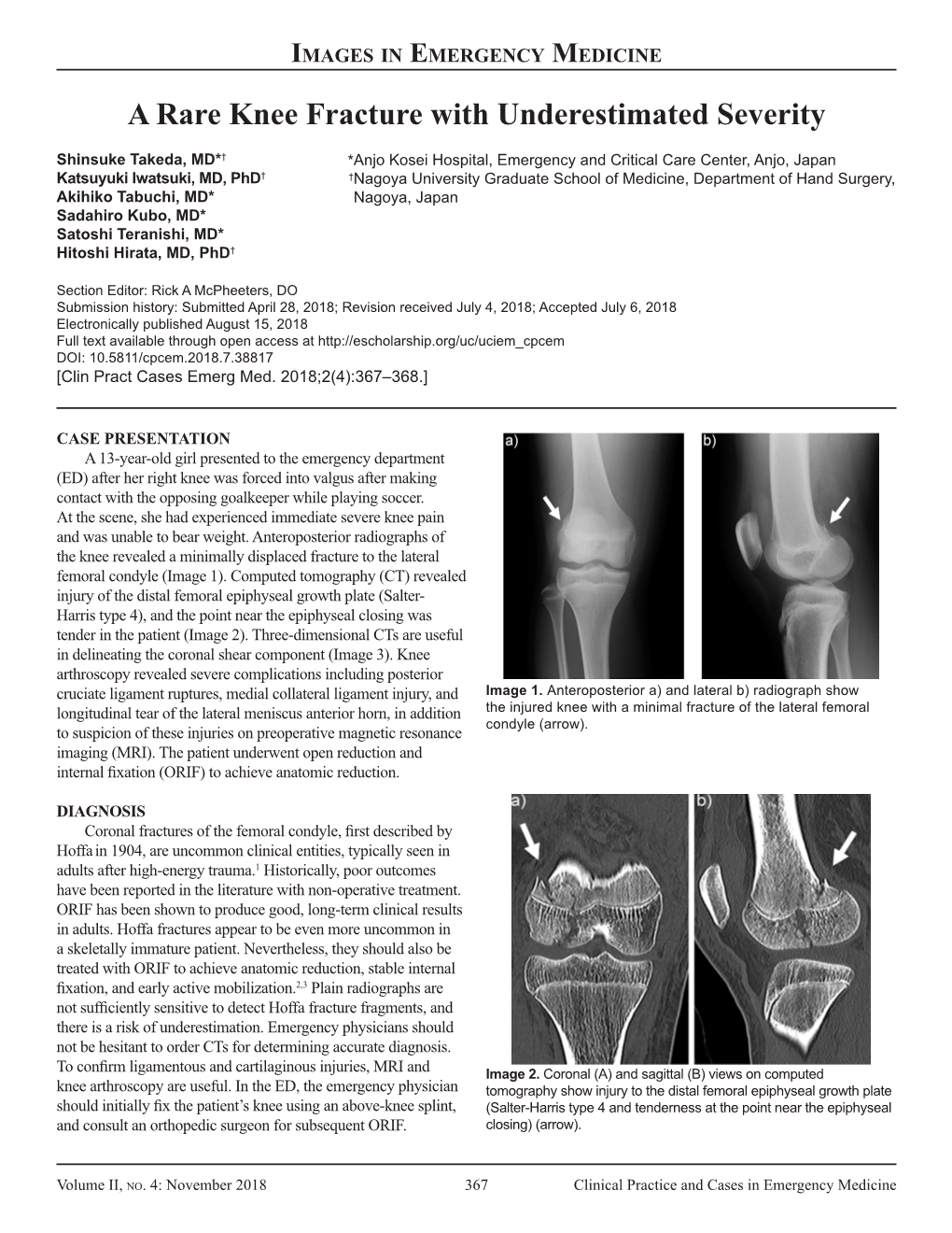 A Rare Knee Fracture with Underestimated Severity