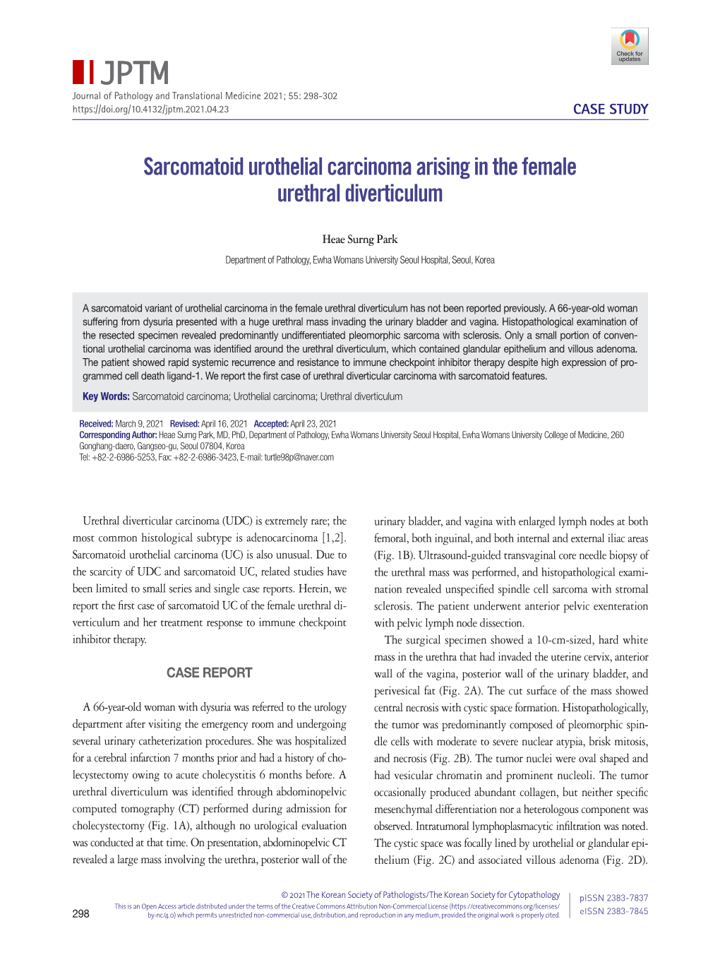 Sarcomatoid Urothelial Carcinoma Arising in the Female Urethral Diverticulum