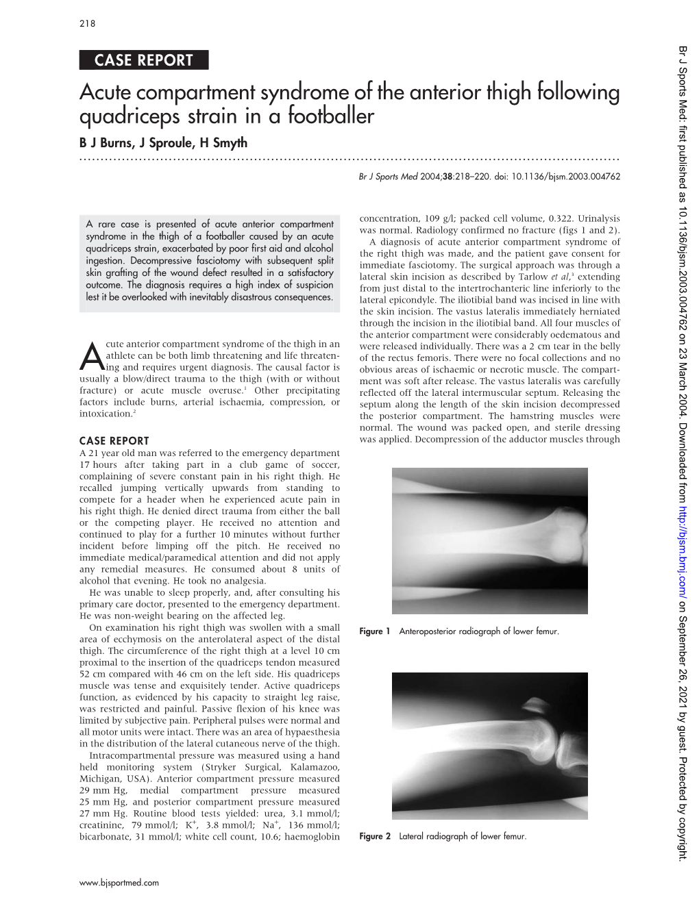 Acute Compartment Syndrome Of The Anterior Thigh Following Quadriceps ...