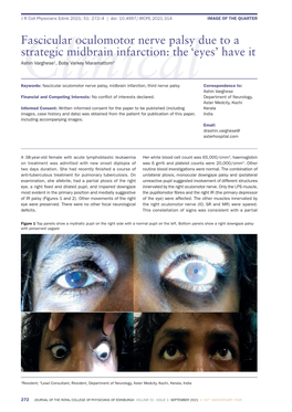 Fascicular Oculomotor Nerve Palsy Due to a Strategic Midbrain Infarction: the ‘Eyes’ Have It Ashin Varghese1, Boby Varkey Maramattom2