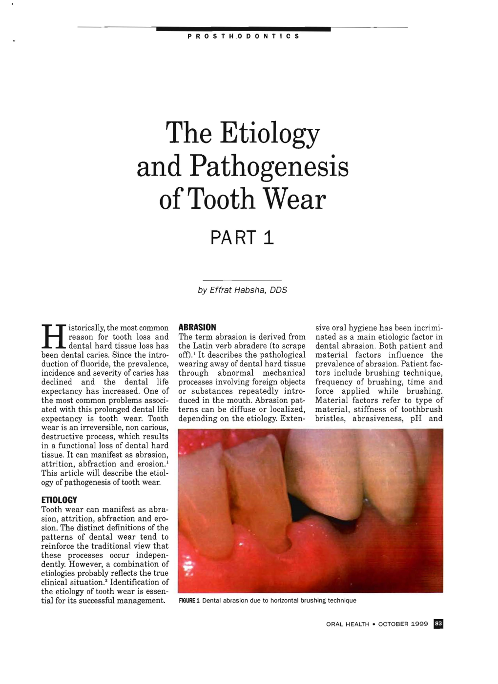 The Etiology and Pathogenesis of Tooth Wear. Oral Health, 1999