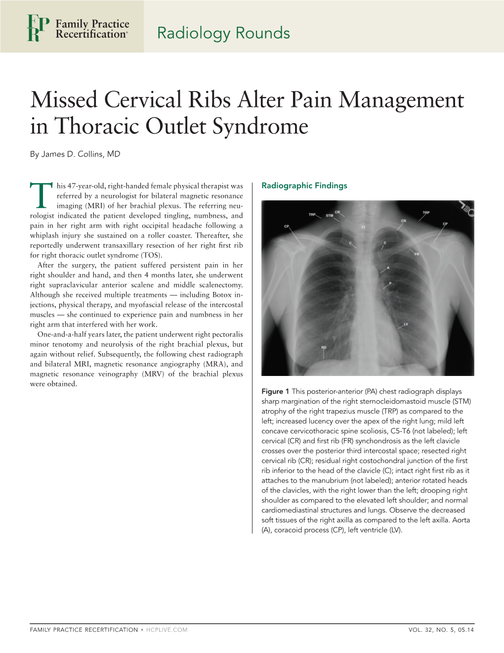 Missed Cervical Ribs Alter Pain Management in Thoracic Outlet Syndrome