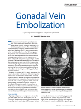 Gonadal Vein Embolization Diagnosing and Treating Pelvic Congestion Syndrome