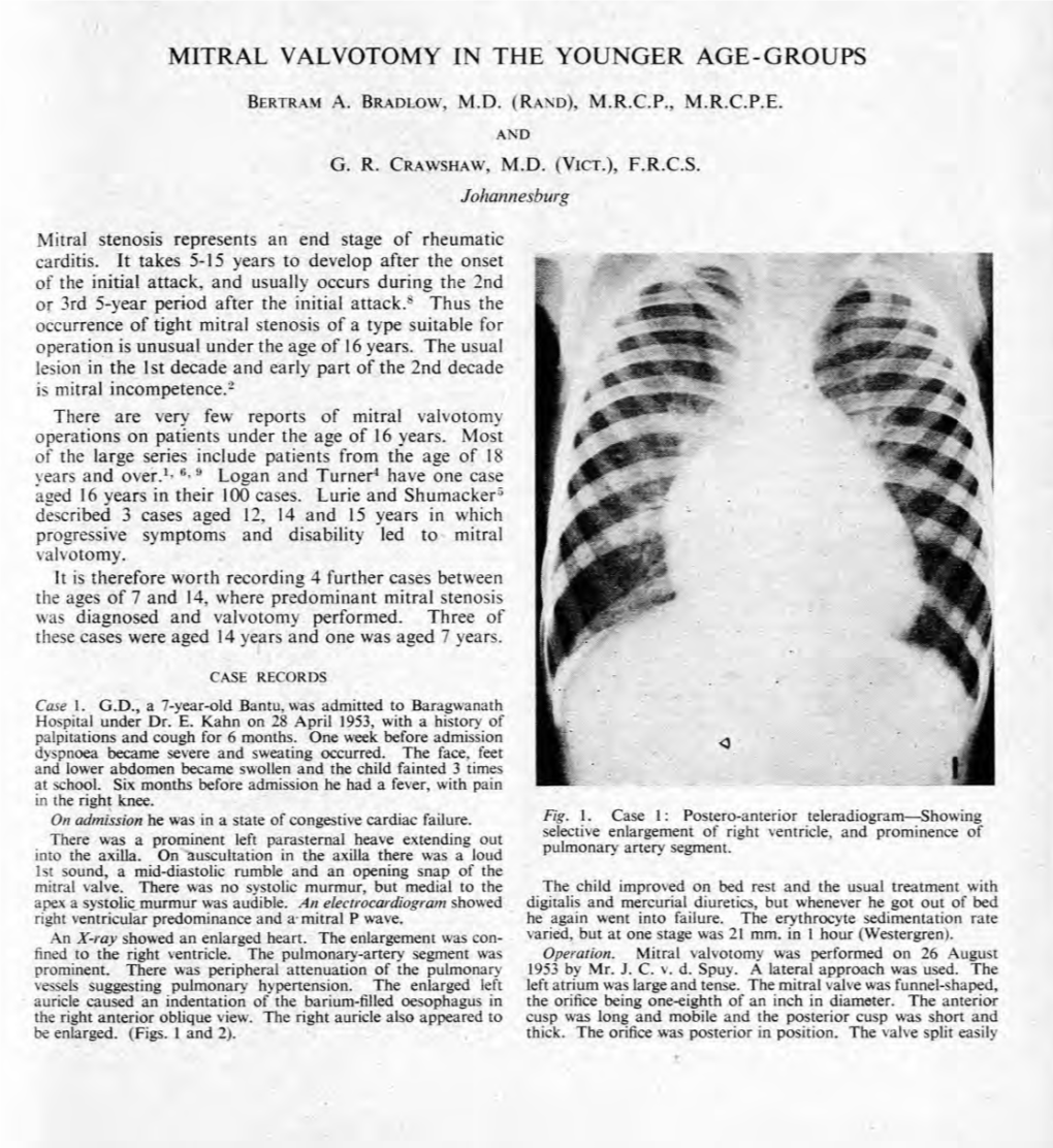 Mitral Valvotomy in the Younger Age-Groups