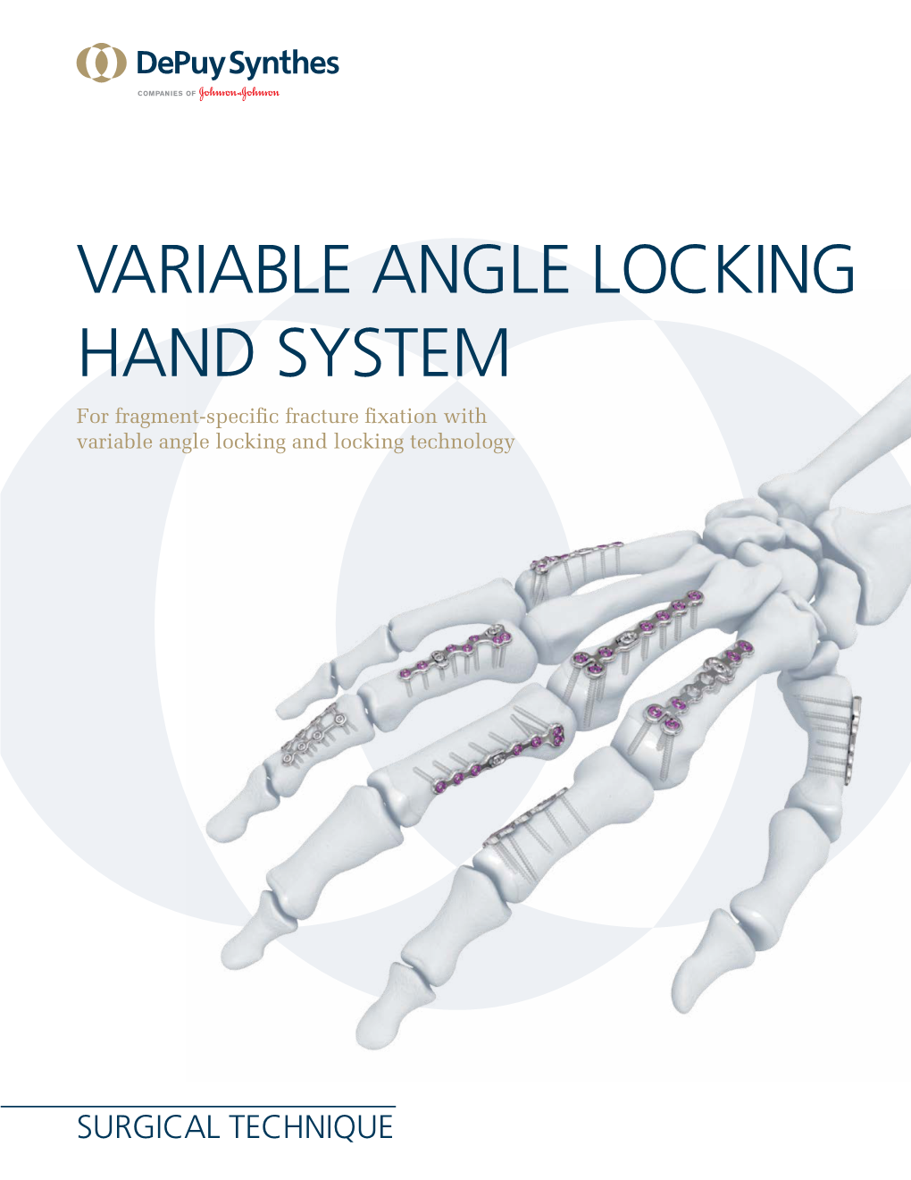 VARIABLE ANGLE LOCKING HAND SYSTEM for Fragment-Specific Fracture Fixation with Variable Angle Locking and Locking Technology