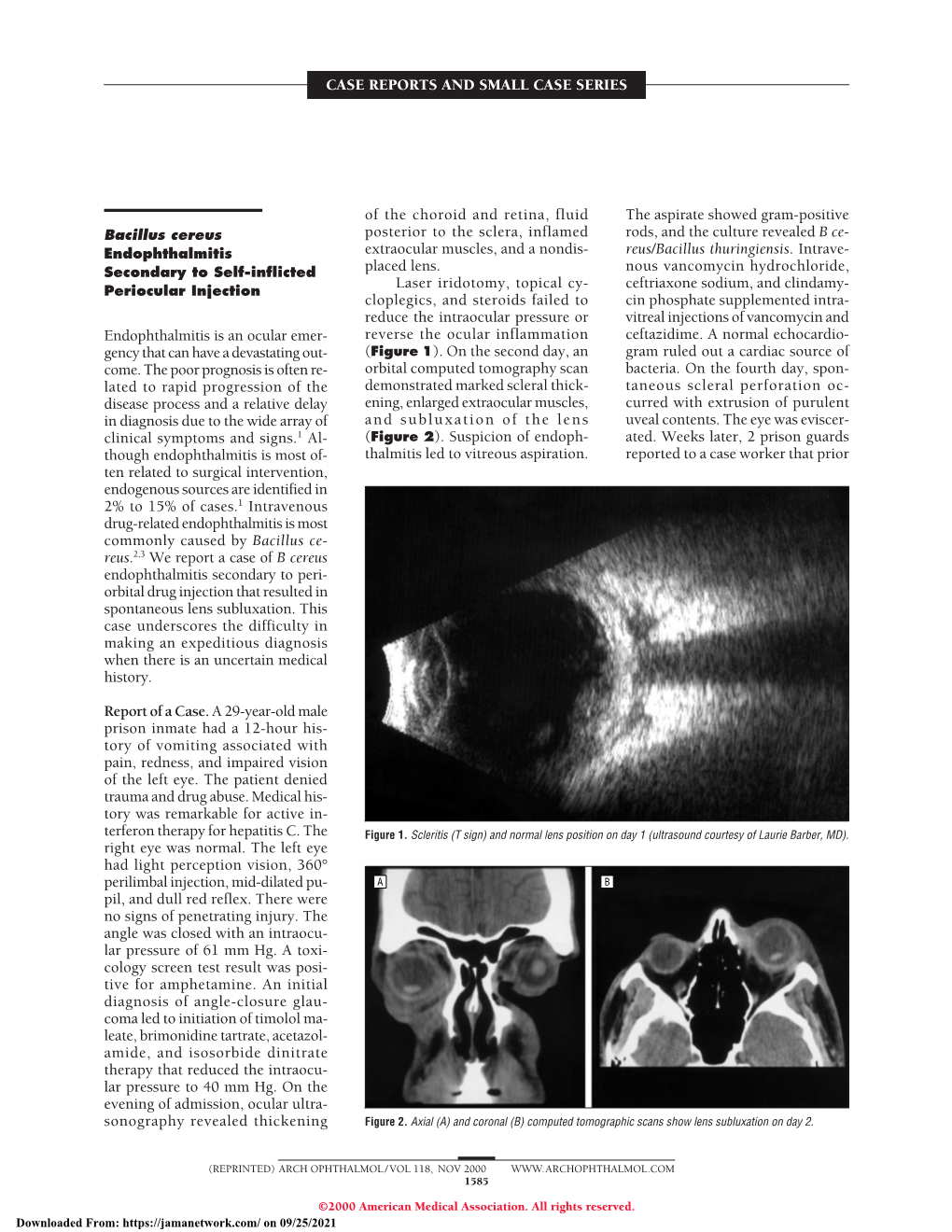 Leber's Hereditary Optic Neuropathy Masquerading As Retinal Vasculitis