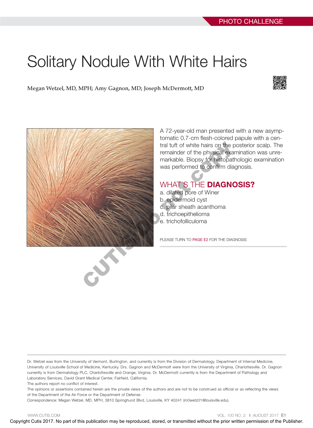 Solitary Nodule with White Hairs