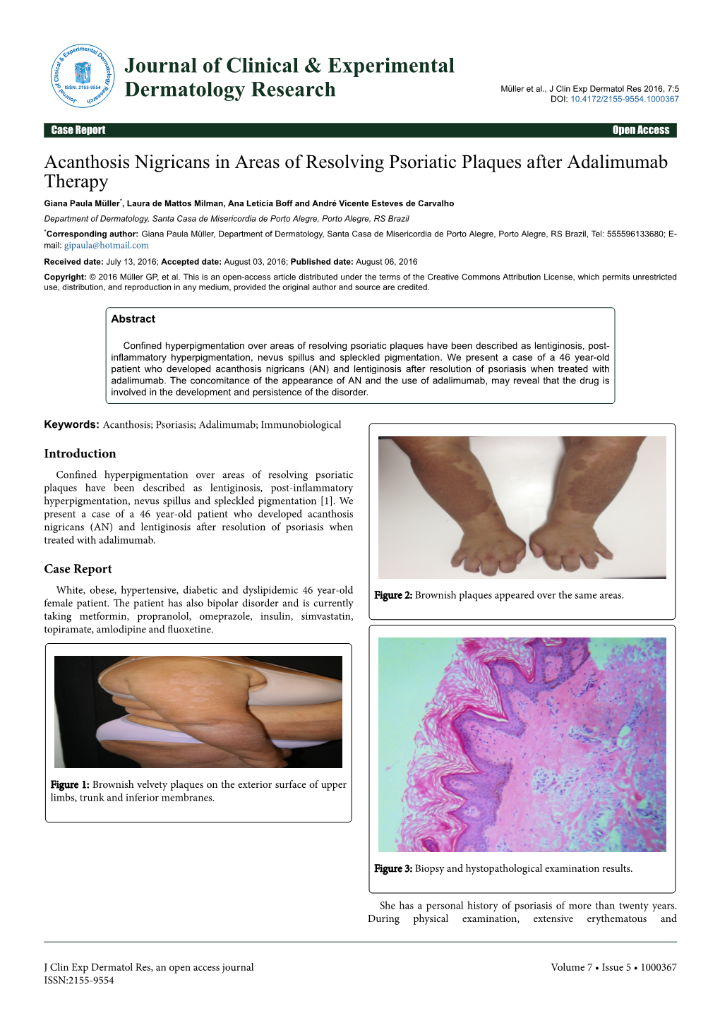 Acanthosis Nigricans in Areas of Resolving Psoriatic Plaques After