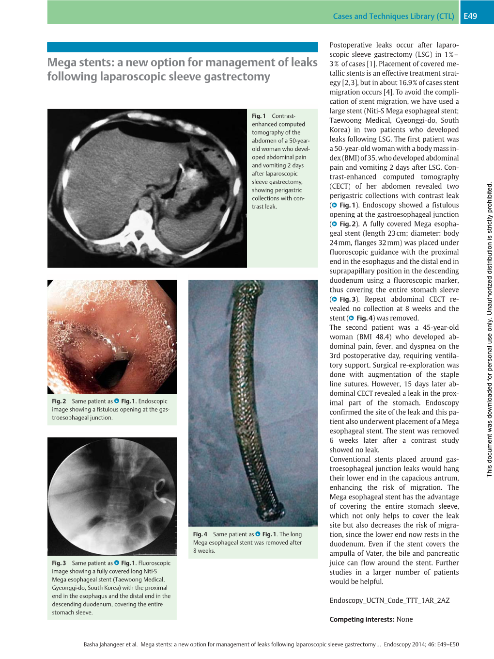 Mega Stents: a New Option for Management of Leaks Following Laparoscopic Sleeve Gastrectomy… Endoscopy 2014; 46: E49–E50 E50 Cases and Techniques Library (CTL)
