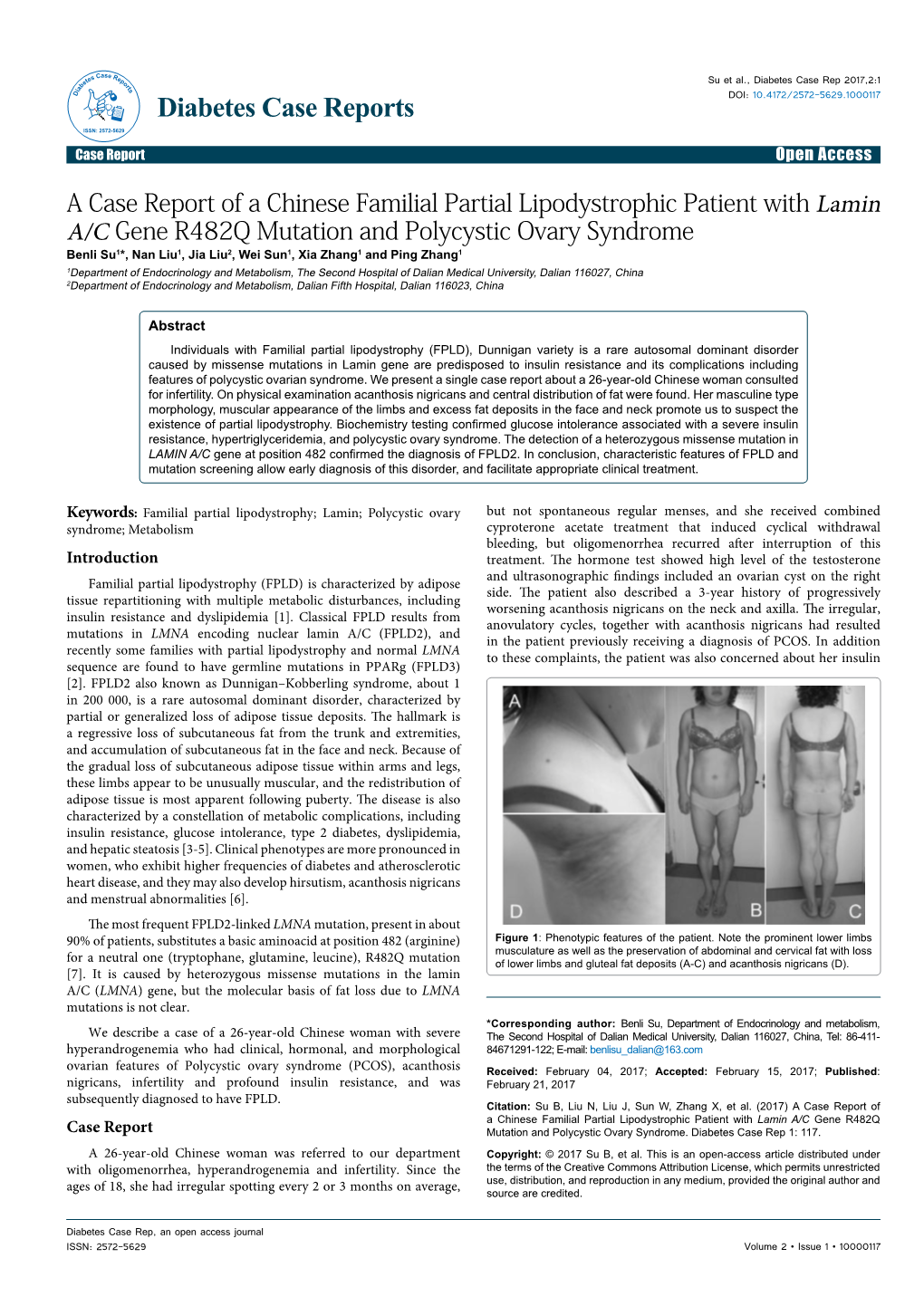 A Case Report of a Chinese Familial Partial Lipodystrophic Patient with Lamin A/C Gene R482Q Mutation and Polycystic Ovary Syndr