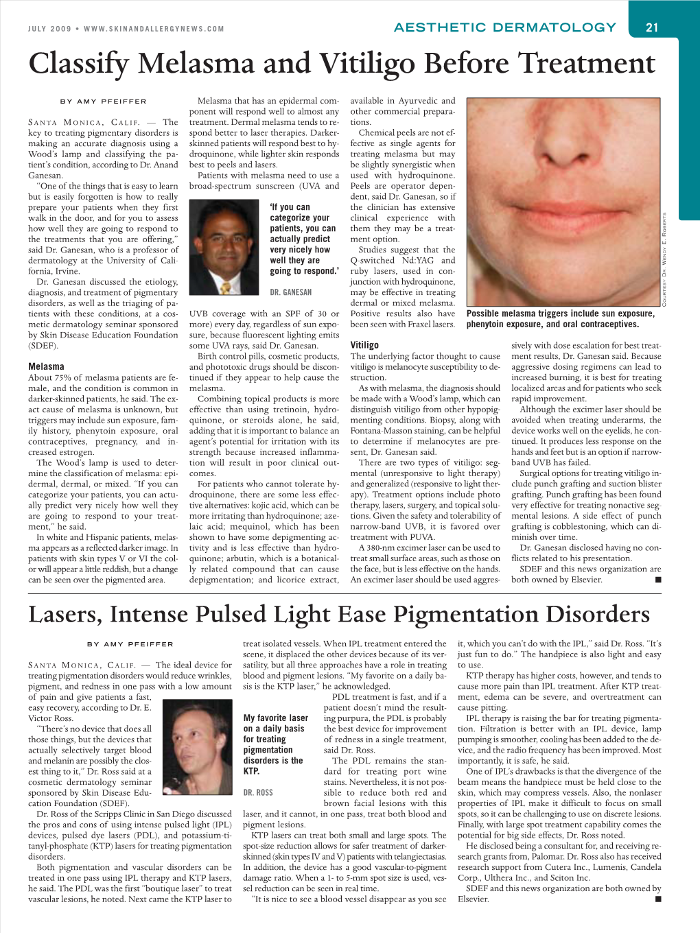 Lasers, Intense Pulsed Light Ease Pigmentation Disorders