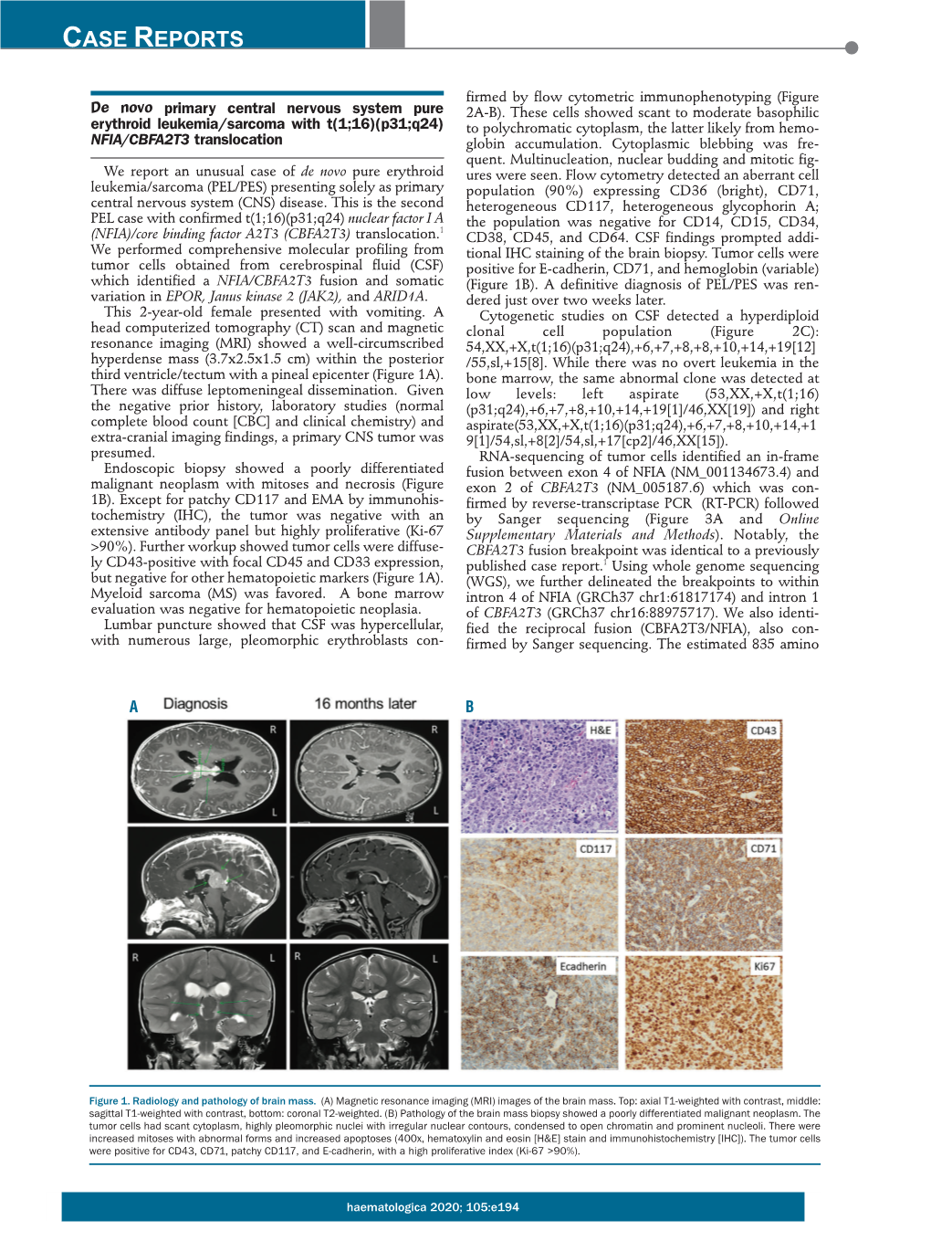 NFIA/CBFA2T3 Translocation Globin Accumulation