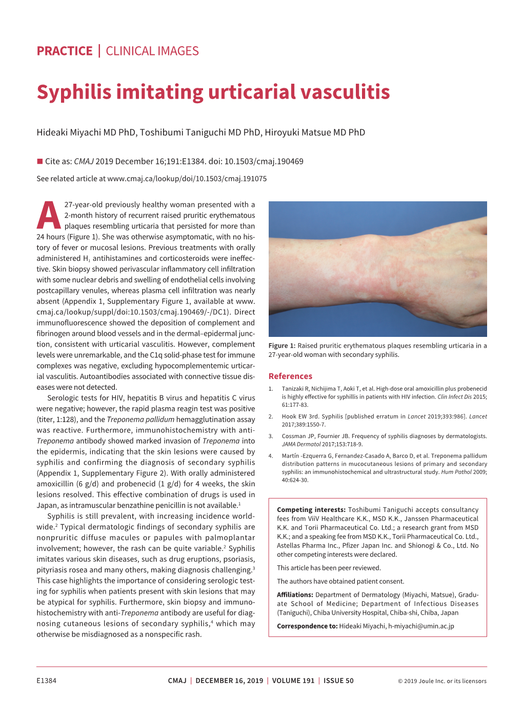 Syphilis Imitating Urticarial Vasculitis