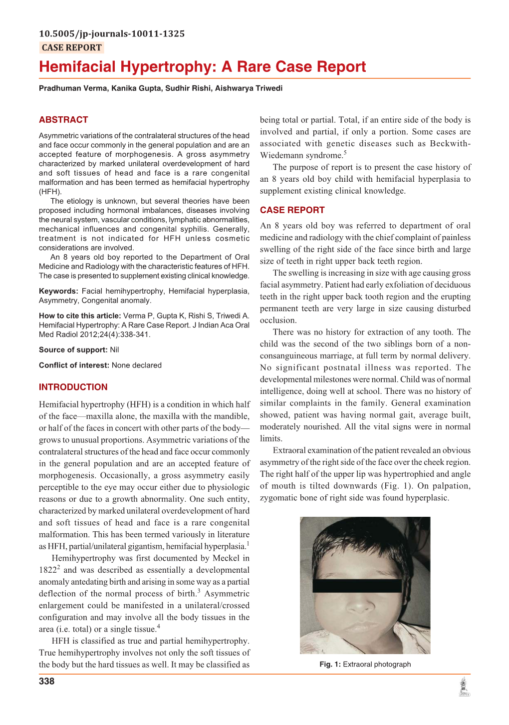 Hemifacial Hypertrophy: a Rare Case Report