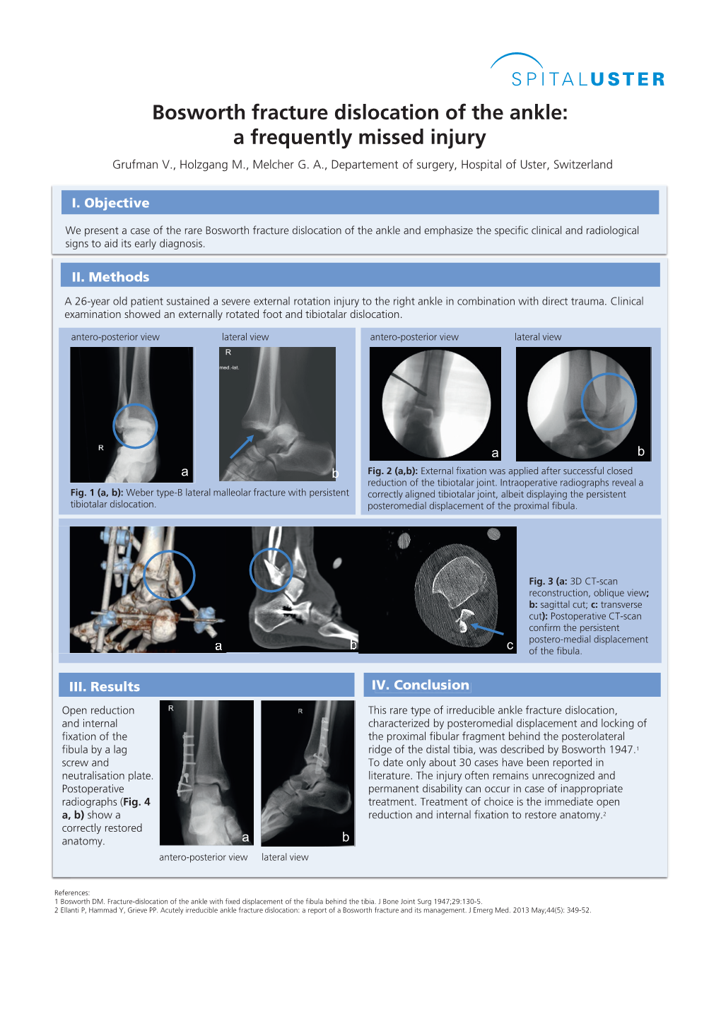 Bosworth Fracture Dislocation of the Ankle: a Frequently Missed Injury Grufman V., Holzgang M., Melcher G