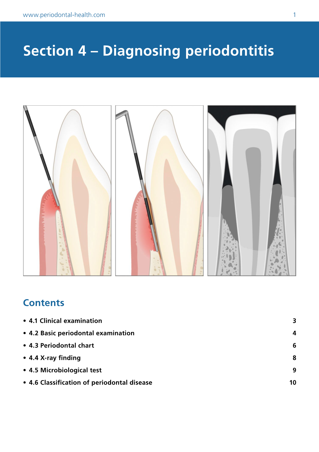 Diagnosing Periodontitis