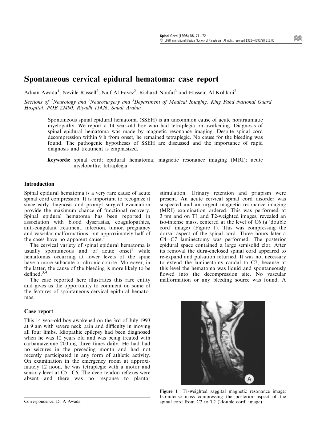 Spontaneous Cervical Epidural Hematoma: Case Report