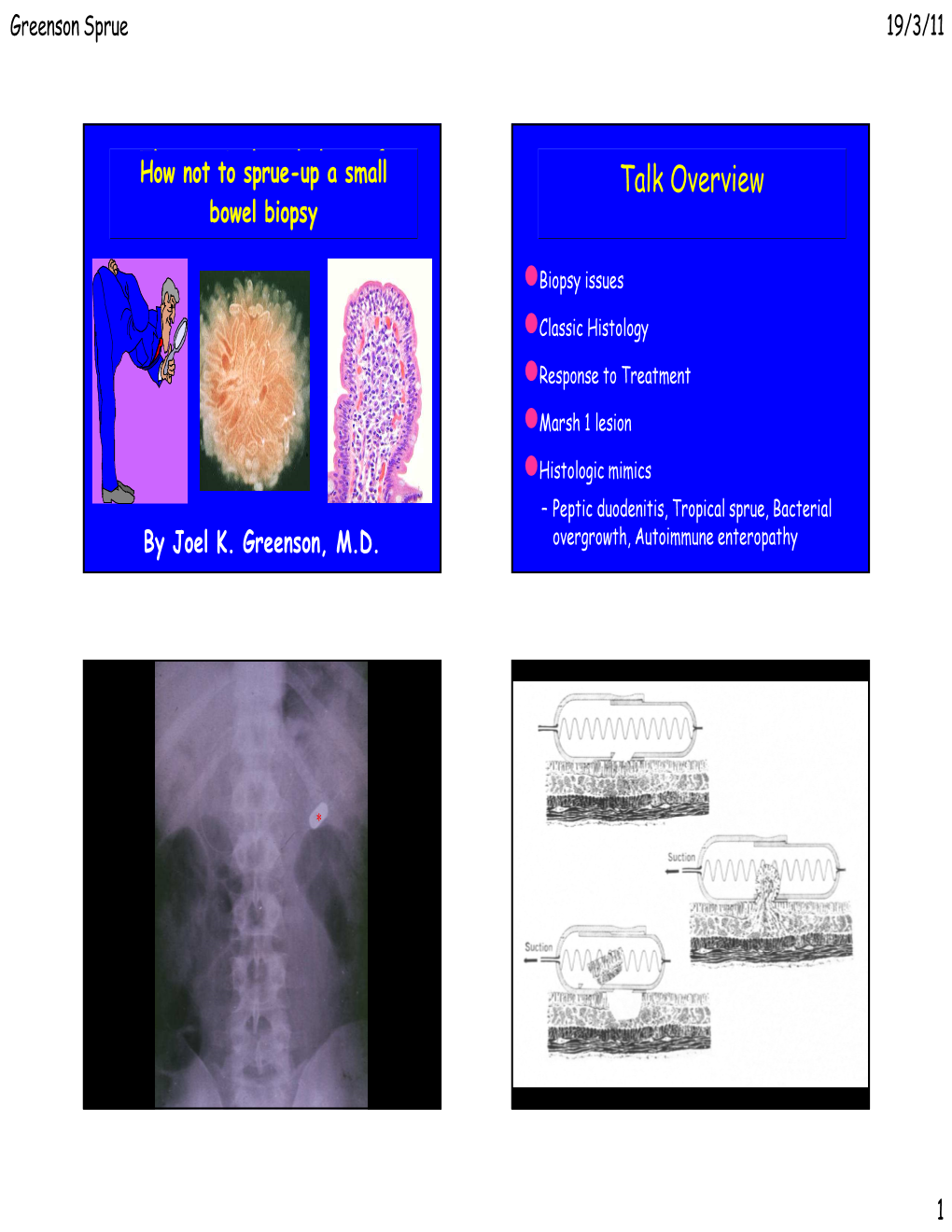 How Not to Sprue up a Small Bowel Biopsy