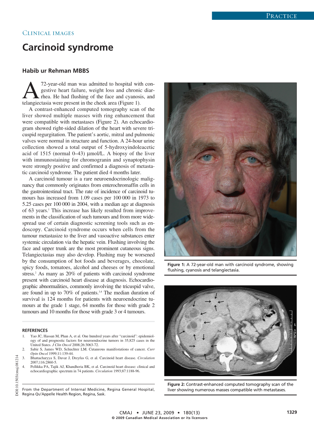 Carcinoid Syndrome