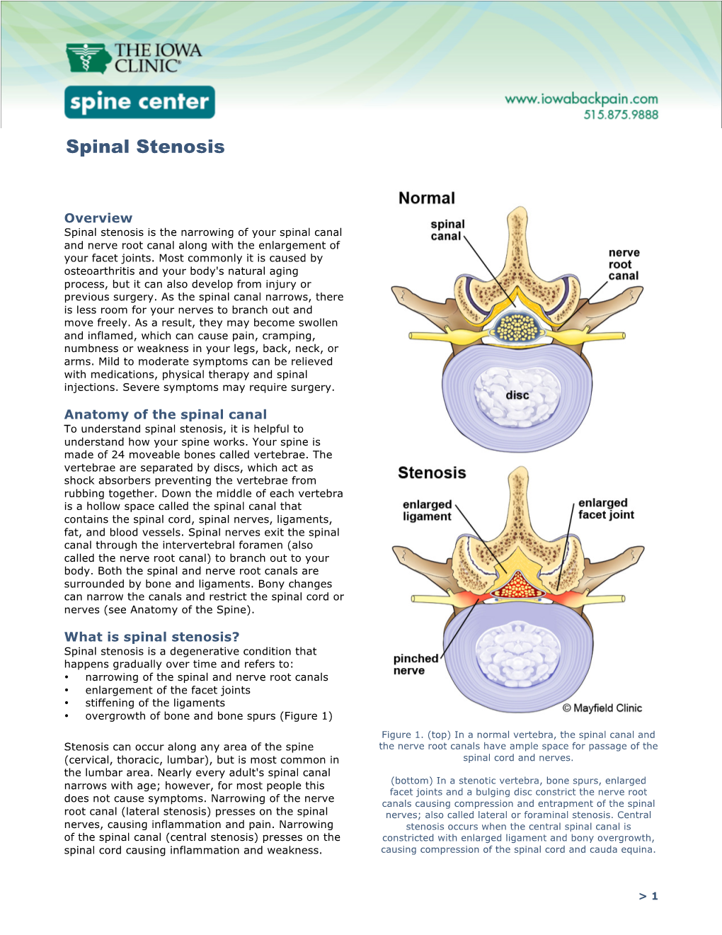 Spinal Stenosis.Pdf