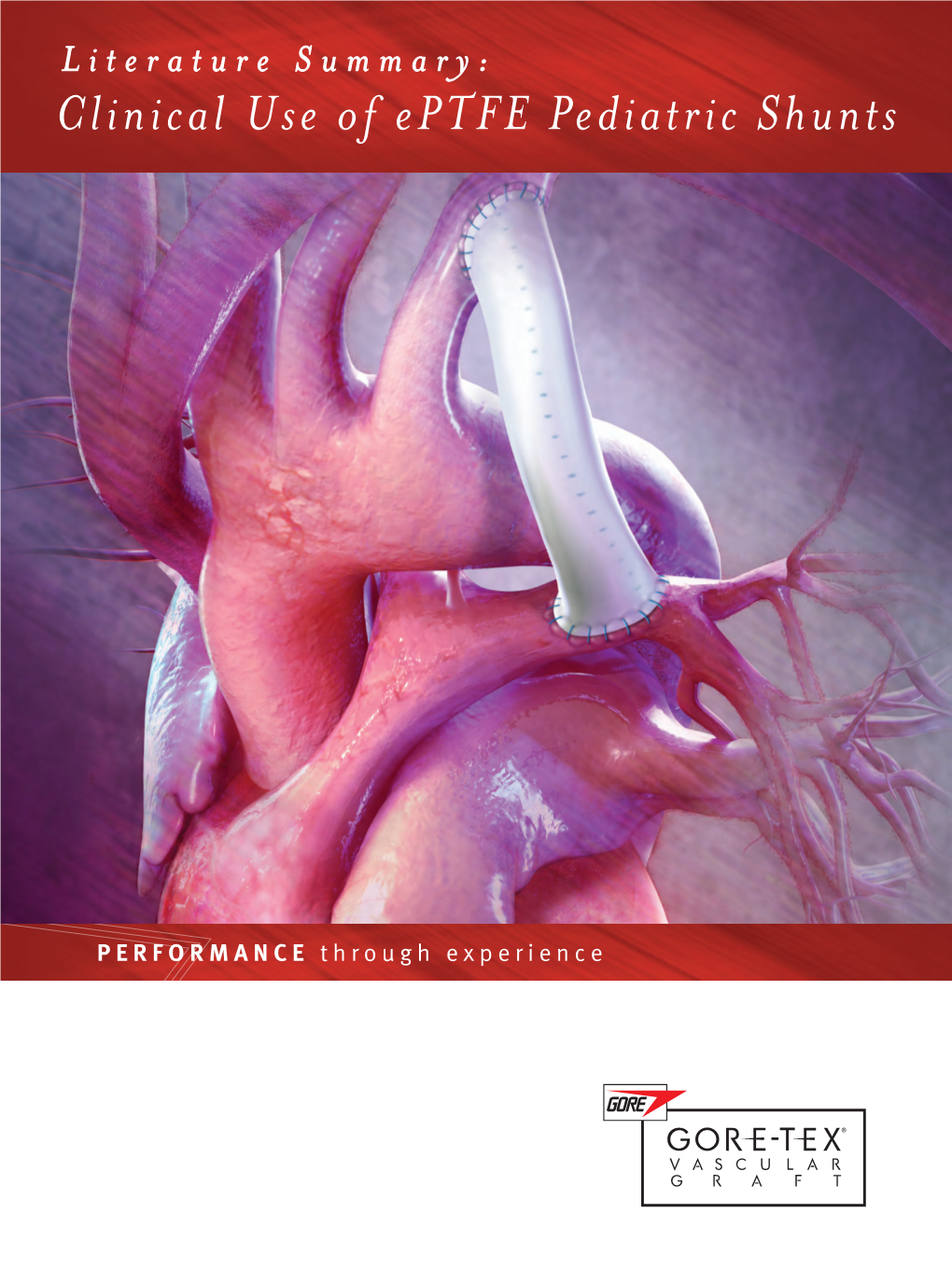 Literature Summary: Clinical Use of Eptfe Pediatric Shunts