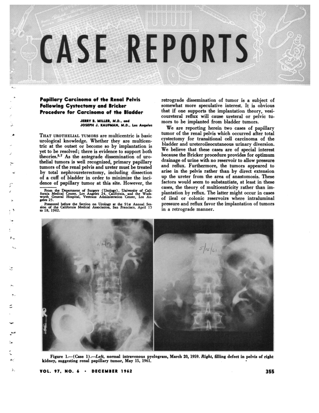 Papillary Carcinoma of the Renal Pelvis Following Cystectomy And